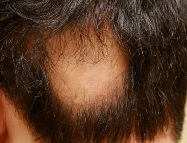 Τύποι αλωπεκίας και τρόποι αντιμετώπισής της